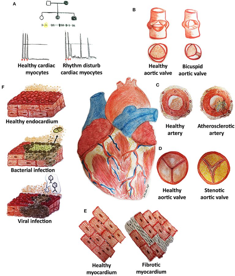 An In-Depth Analysis Of Heart Disease: Unraveling The Complexities And Strategies For Prevention